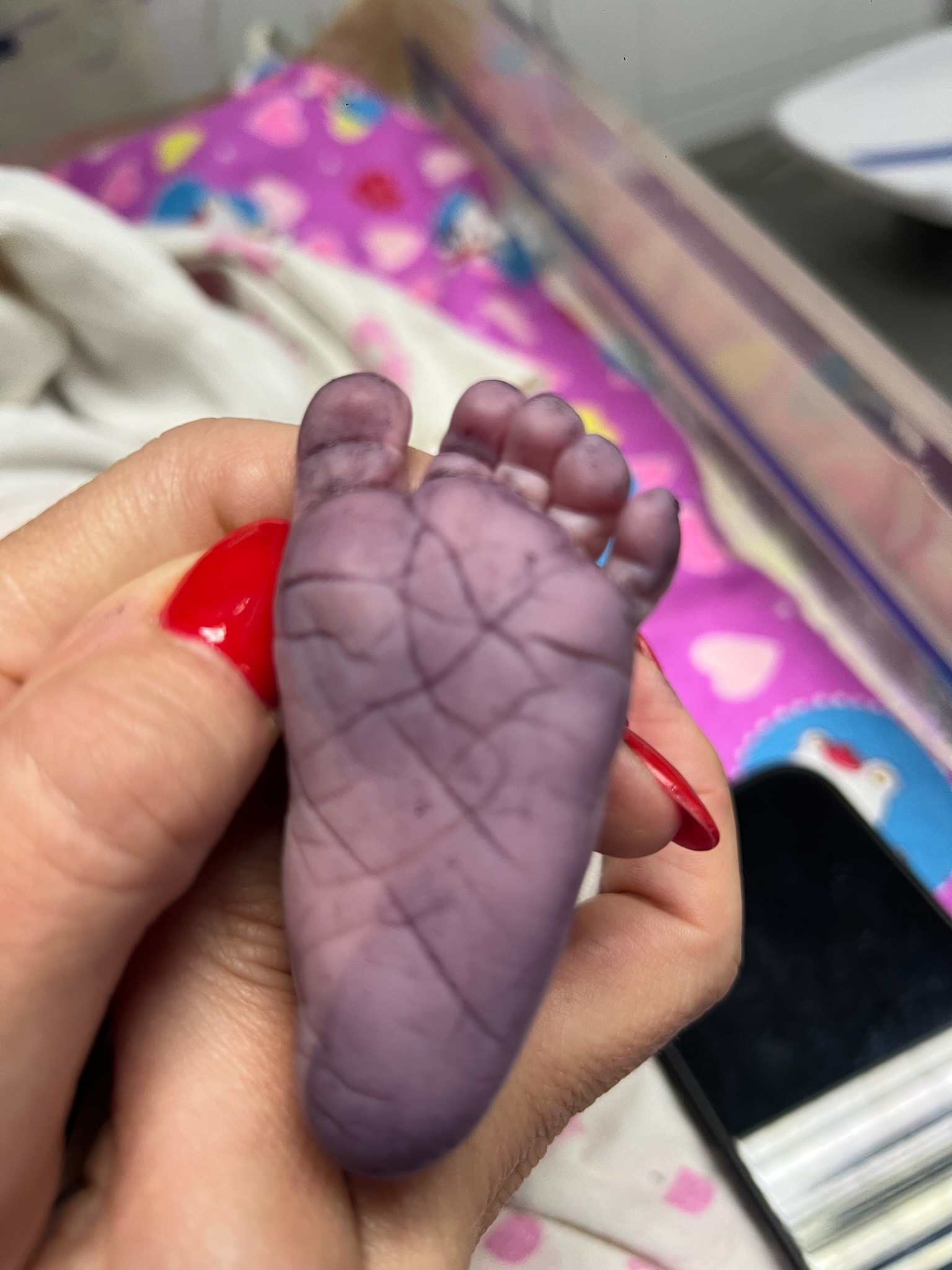 Baby foot cast held in a hand